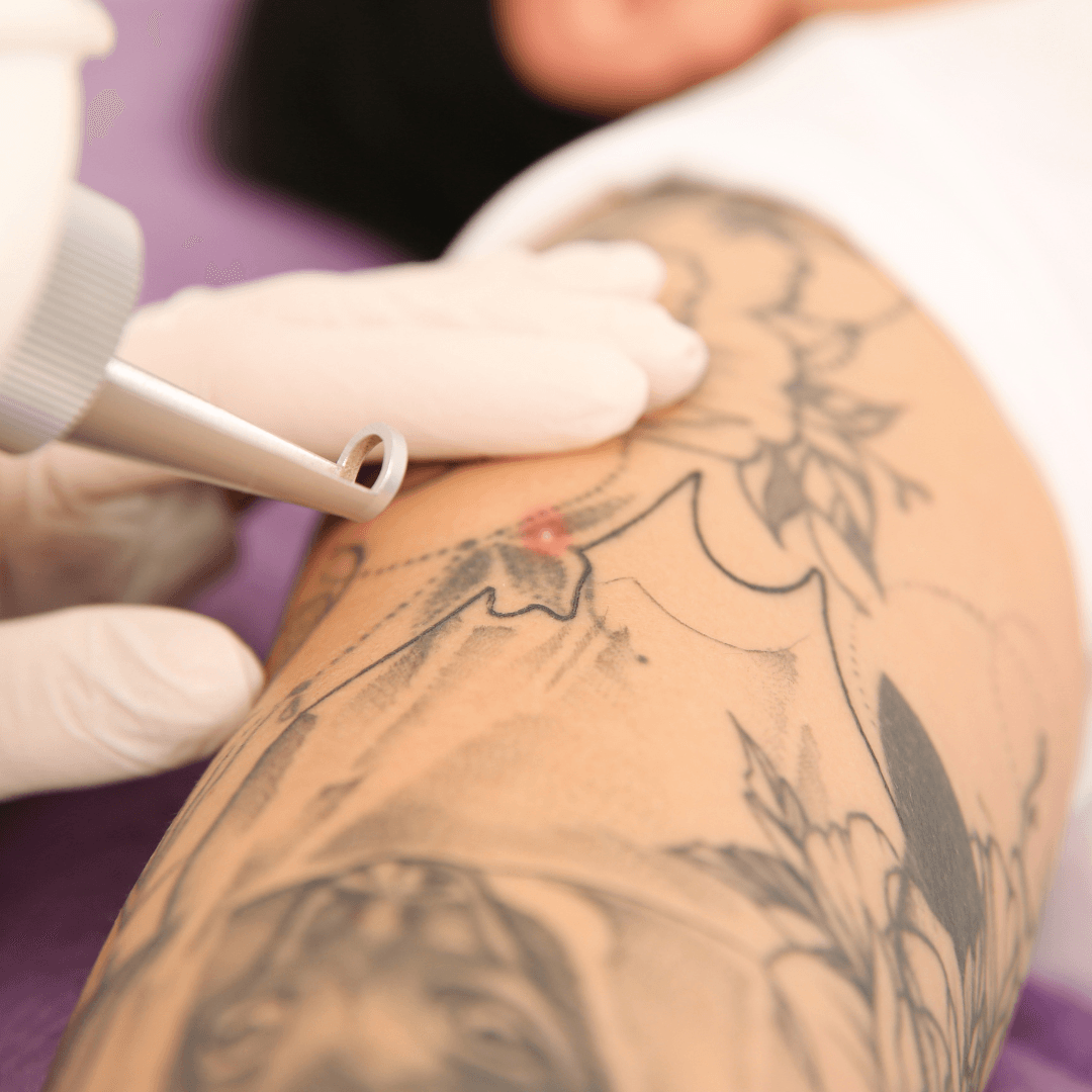 Centro Médico y Dental Kinefisio ELIMINACIÓN DE TATUAJES y cicatrices “TECNOLOGÍA DE LÁSER ND YAG”